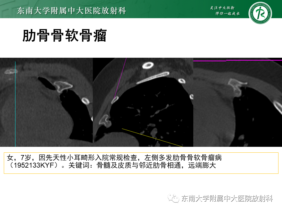 影像PPT - 【病例】肋骨孤立性溶骨性病变病例讨论-32