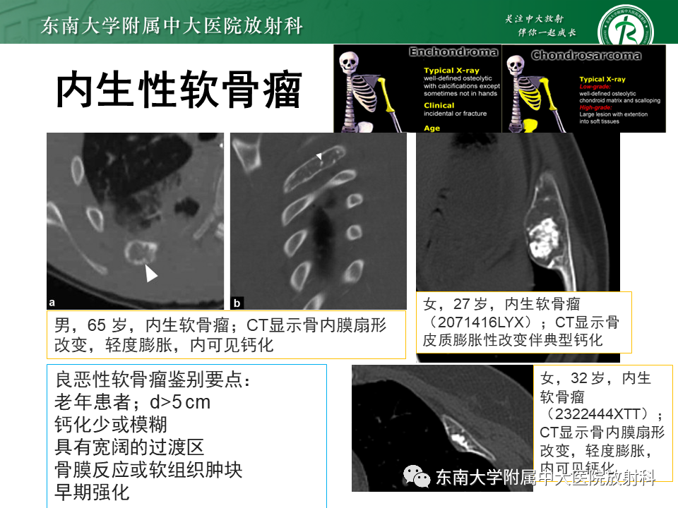 影像PPT - 【病例】肋骨孤立性溶骨性病变病例讨论-34