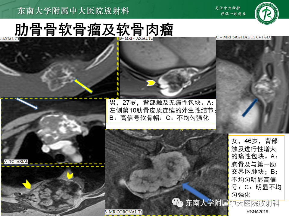 影像PPT - 【病例】肋骨孤立性溶骨性病变病例讨论-33