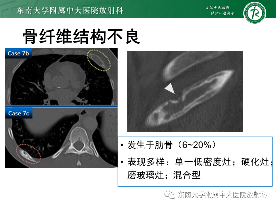 影像PPT - 【病例】肋骨孤立性溶骨性病变病例讨论-36