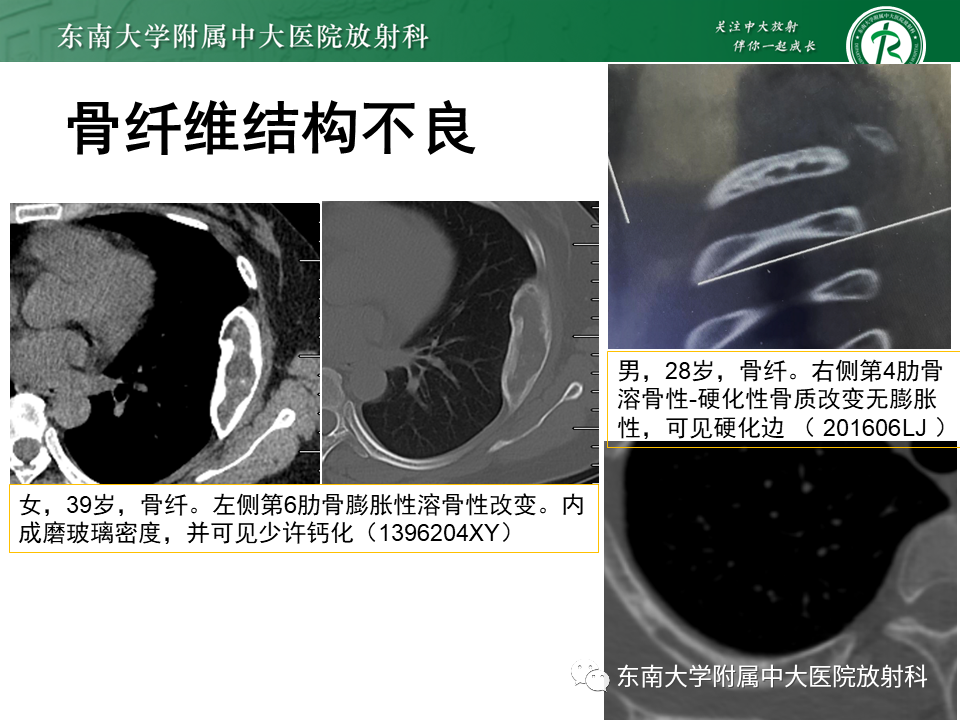 影像PPT - 【病例】肋骨孤立性溶骨性病变病例讨论-37