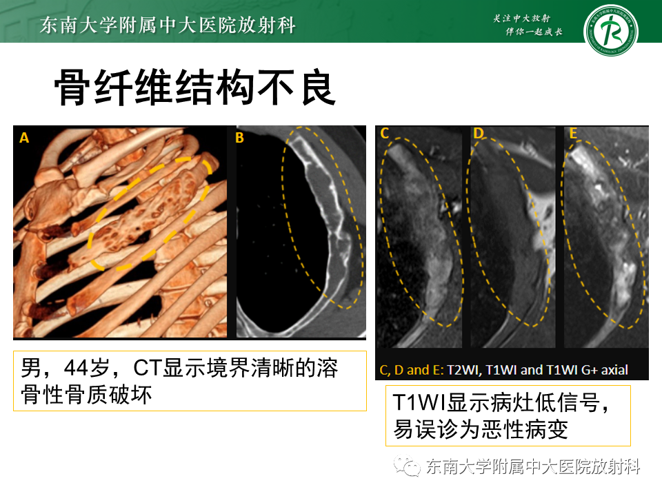 影像PPT - 【病例】肋骨孤立性溶骨性病变病例讨论-38