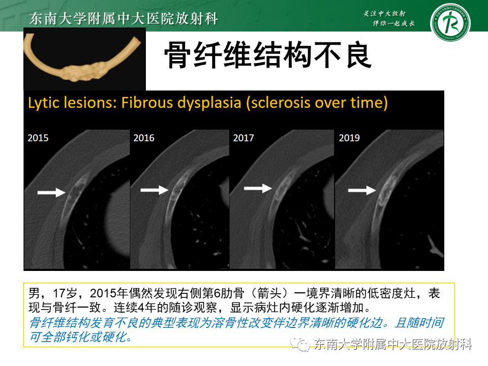 影像PPT - 【病例】肋骨孤立性溶骨性病变病例讨论-39