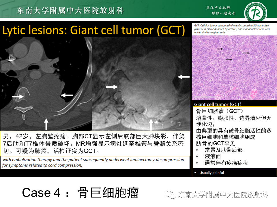 影像PPT - 【病例】肋骨孤立性溶骨性病变病例讨论-40