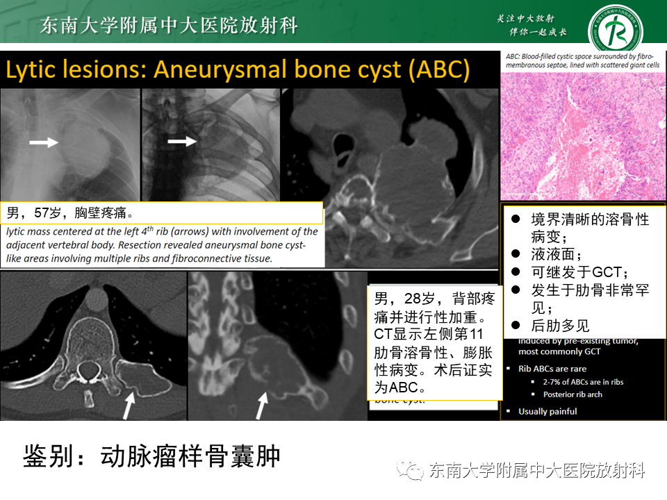 影像PPT - 【病例】肋骨孤立性溶骨性病变病例讨论-41
