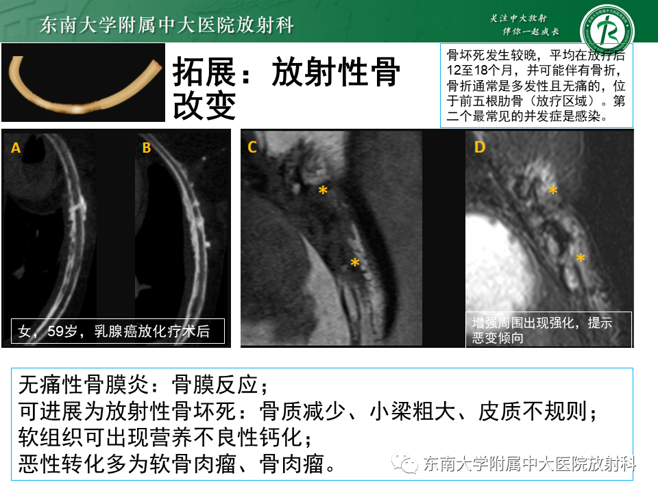 影像PPT - 【病例】肋骨孤立性溶骨性病变病例讨论-43