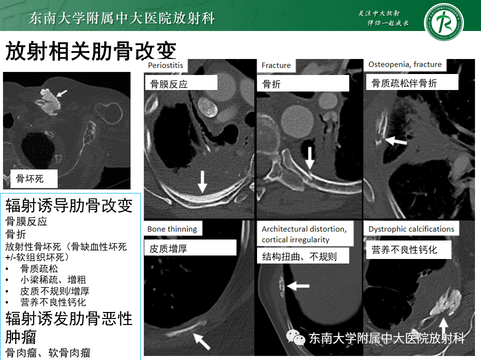 影像PPT - 【病例】肋骨孤立性溶骨性病变病例讨论-44