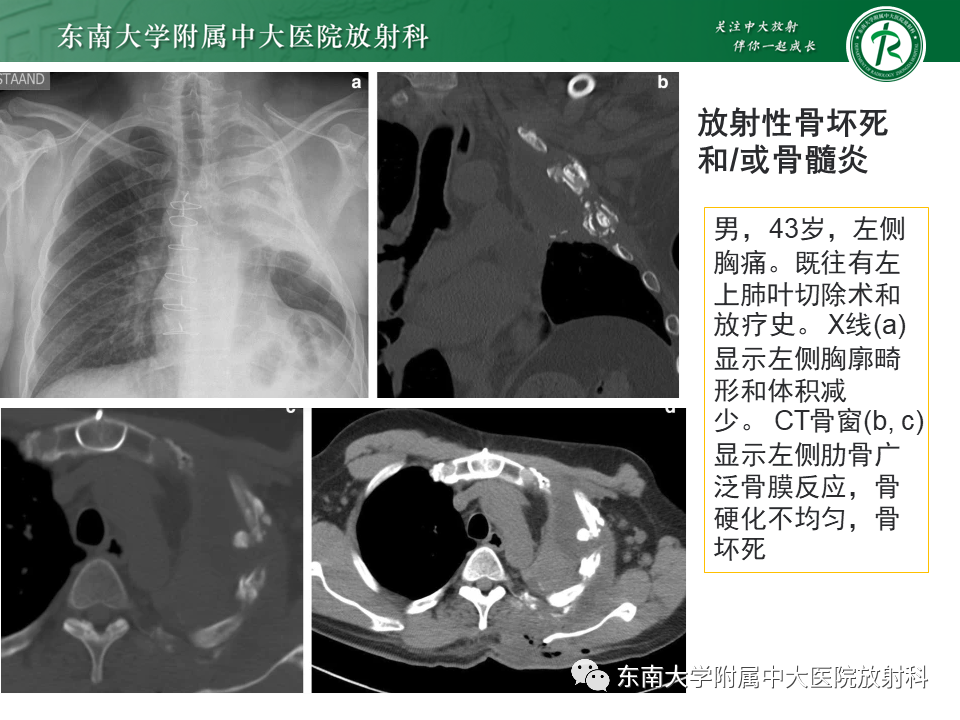 影像PPT - 【病例】肋骨孤立性溶骨性病变病例讨论-45