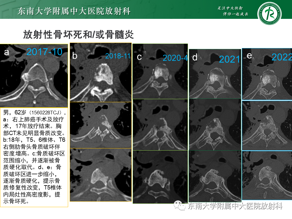 影像PPT - 【病例】肋骨孤立性溶骨性病变病例讨论-46