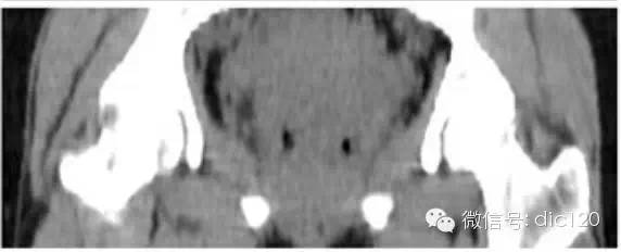 影像PPT - 【病例】猫眼征—双子宫双宫颈双阴道1例X线CT影像-3 影像PPT - 【病例】猫眼征—双子宫双宫颈双阴道1例X线CT影像-3