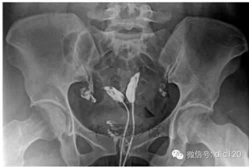 影像PPT - 【病例】猫眼征—双子宫双宫颈双阴道1例X线CT影像-4 影像PPT - 【病例】猫眼征—双子宫双宫颈双阴道1例X线CT影像-4