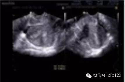影像PPT - 【病例】猫眼征—双子宫双宫颈双阴道1例X线CT影像-5 影像PPT - 【病例】猫眼征—双子宫双宫颈双阴道1例X线CT影像-5