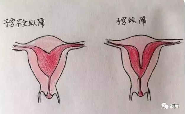 影像PPT - 【病例】猫眼征—双子宫双宫颈双阴道1例X线CT影像-6 影像PPT - 【病例】猫眼征—双子宫双宫颈双阴道1例X线CT影像-6