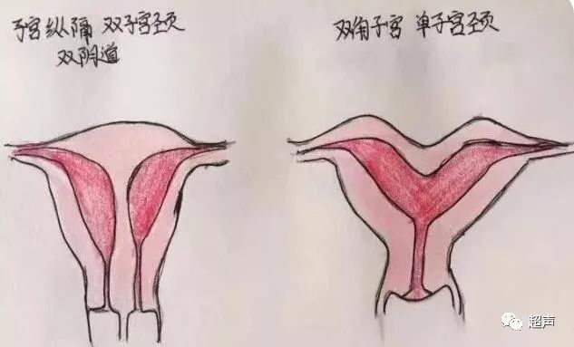 影像PPT - 【病例】猫眼征—双子宫双宫颈双阴道1例X线CT影像-7 影像PPT - 【病例】猫眼征—双子宫双宫颈双阴道1例X线CT影像-7