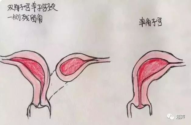 影像PPT - 【病例】猫眼征—双子宫双宫颈双阴道1例X线CT影像-9 影像PPT - 【病例】猫眼征—双子宫双宫颈双阴道1例X线CT影像-9