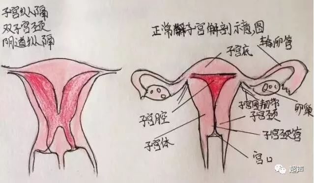 影像PPT - 【病例】猫眼征—双子宫双宫颈双阴道1例X线CT影像-10 影像PPT - 【病例】猫眼征—双子宫双宫颈双阴道1例X线CT影像-10