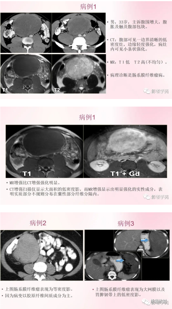 影像PPT - 【病例】肠系膜韧带样纤维瘤1例CT影像-7 影像PPT - 【病例】肠系膜韧带样纤维瘤1例CT影像-7
