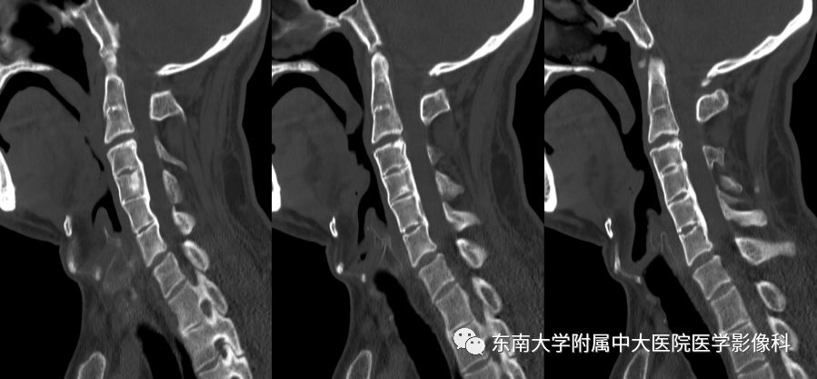 影像PPT - 【PPT】颅底凹陷症-2