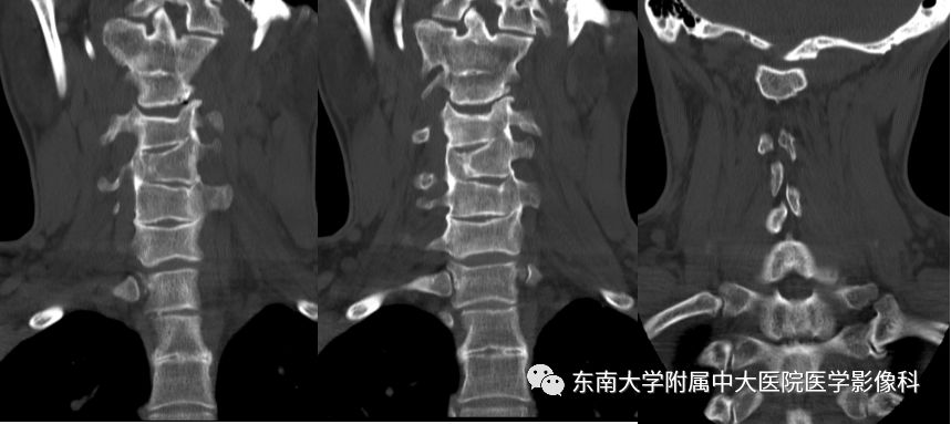 影像PPT - 【PPT】颅底凹陷症-3