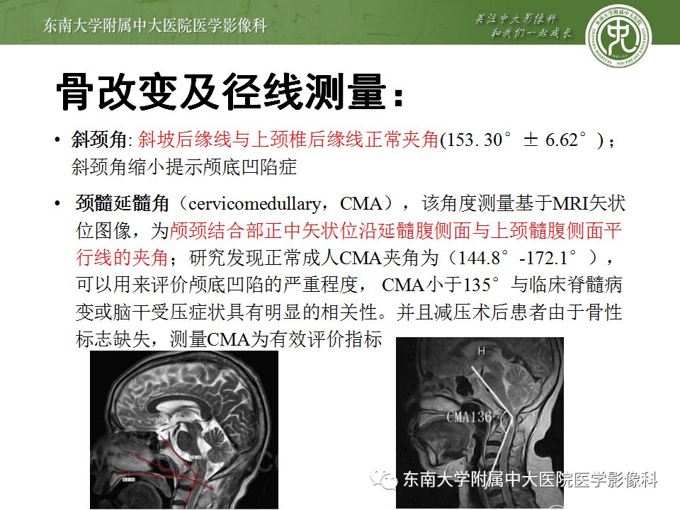 影像PPT - 【PPT】颅底凹陷症-12