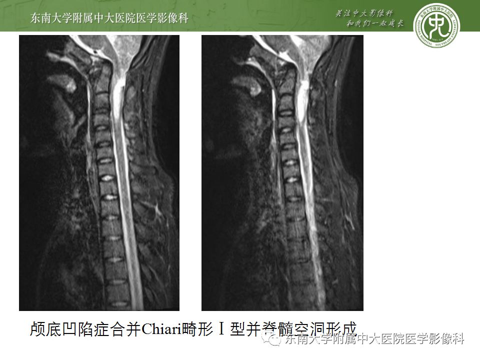 影像PPT - 【PPT】颅底凹陷症-15