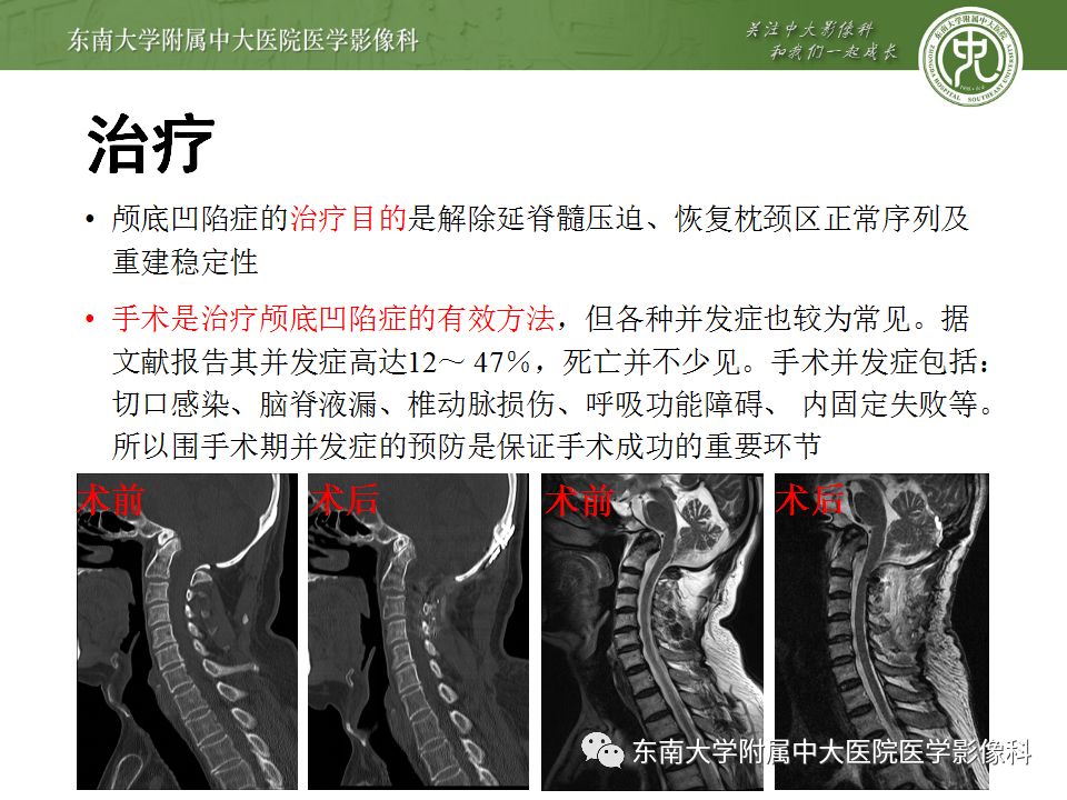 影像PPT - 【PPT】颅底凹陷症-16