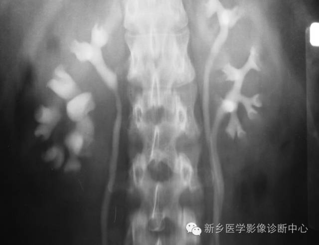 影像PPT - 发生在肾脏的“无面征”-4