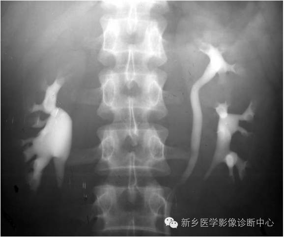 影像PPT - 发生在肾脏的“无面征”-3