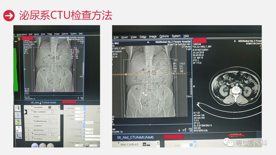 影像PPT - 【PPT】泌尿系CTU扫描技术-20