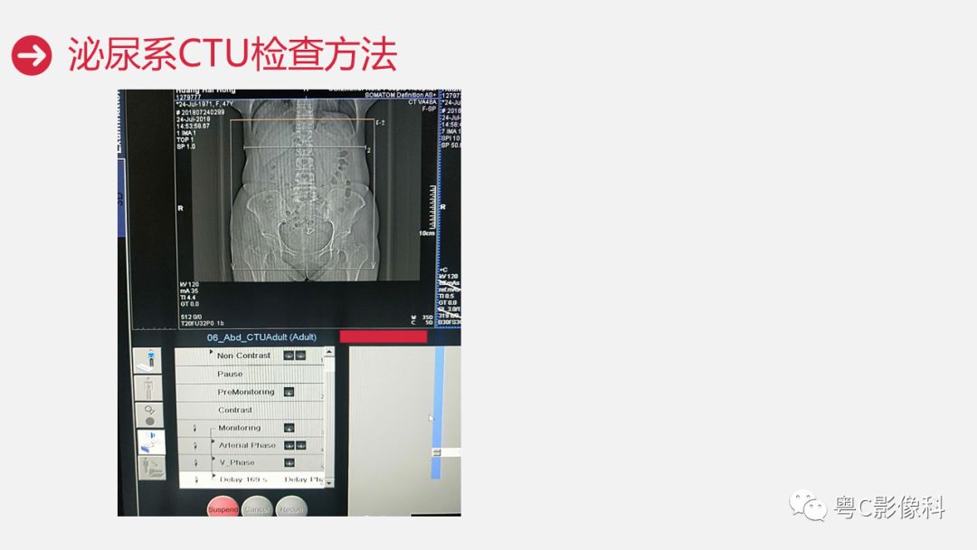 影像PPT - 【PPT】泌尿系CTU扫描技术-21