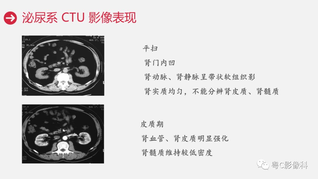影像PPT - 【PPT】泌尿系CTU扫描技术-23