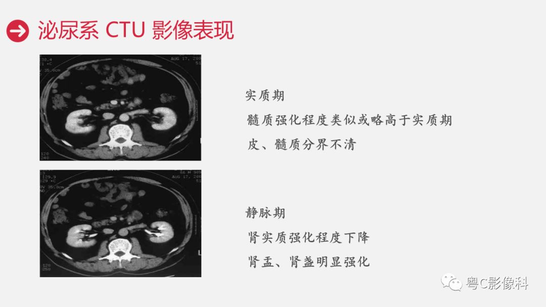 影像PPT - 【PPT】泌尿系CTU扫描技术-24