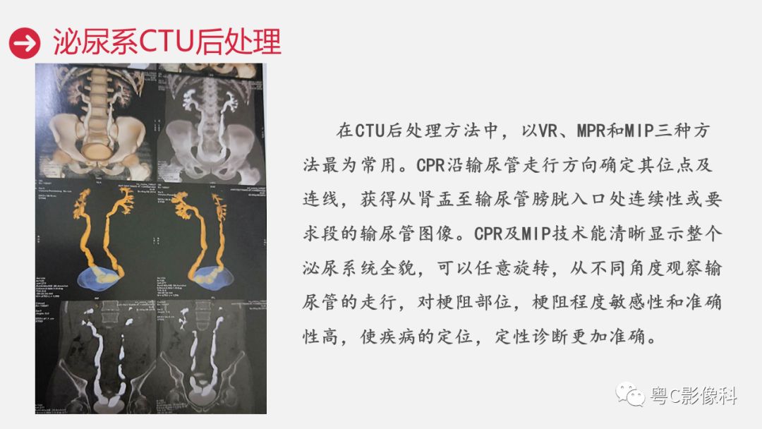 影像PPT - 【PPT】泌尿系CTU扫描技术-27