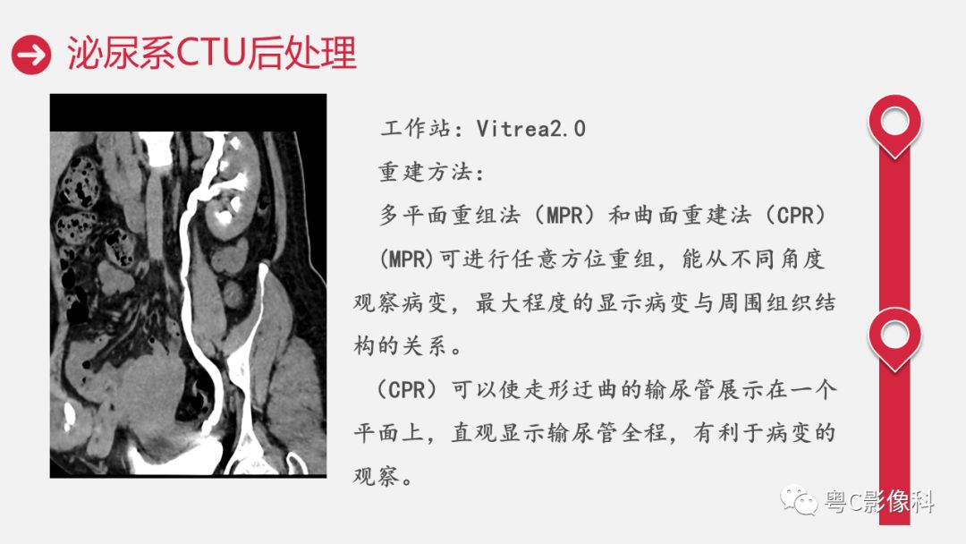 影像PPT - 【PPT】泌尿系CTU扫描技术-28