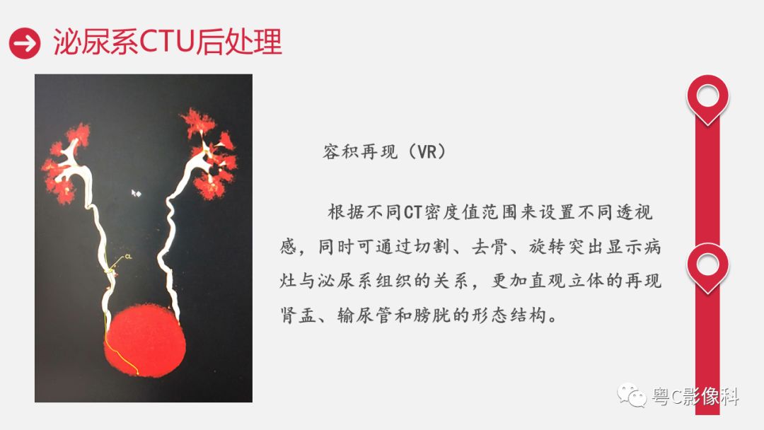 影像PPT - 【PPT】泌尿系CTU扫描技术-29