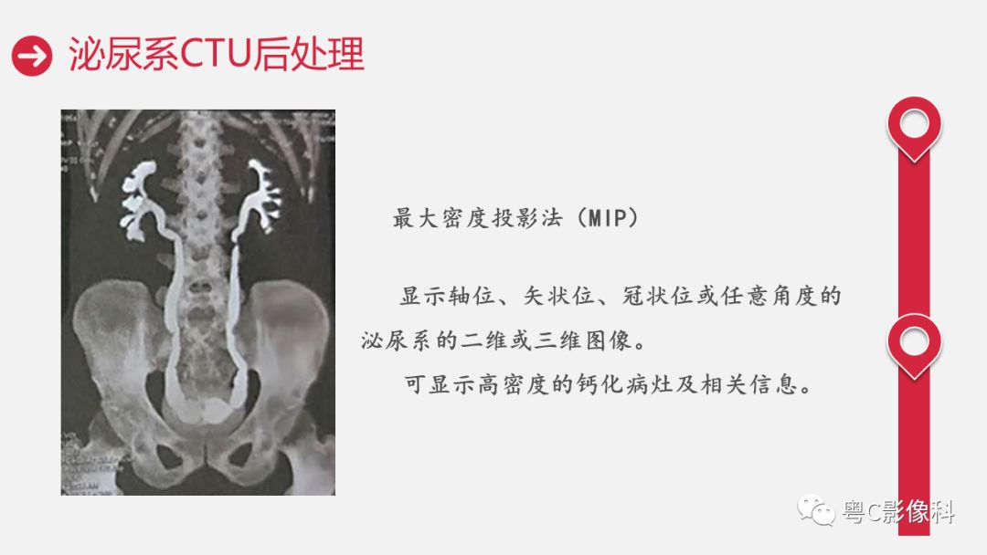 影像PPT - 【PPT】泌尿系CTU扫描技术-30