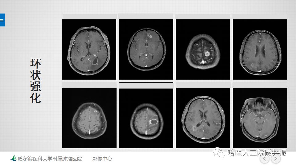 影像PPT - 【PPT】脑内环形强化 除了转移瘤你能想到什么-3