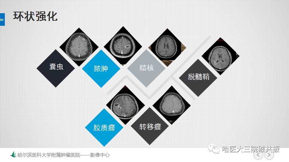 影像PPT - 【PPT】脑内环形强化 除了转移瘤你能想到什么-4