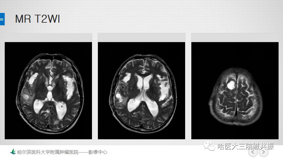 影像PPT - 【PPT】脑内环形强化 除了转移瘤你能想到什么-6
