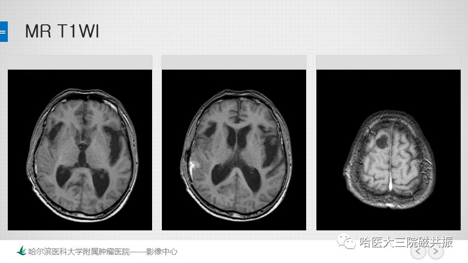 影像PPT - 【PPT】脑内环形强化 除了转移瘤你能想到什么-7