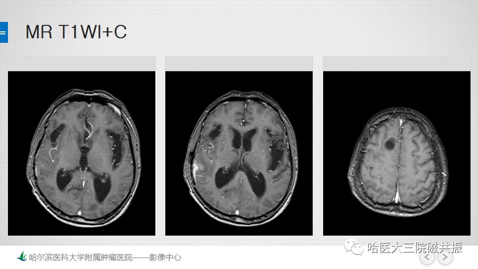 影像PPT - 【PPT】脑内环形强化 除了转移瘤你能想到什么-8
