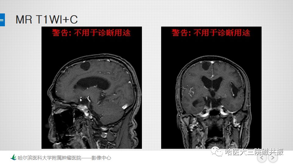 影像PPT - 【PPT】脑内环形强化 除了转移瘤你能想到什么-9
