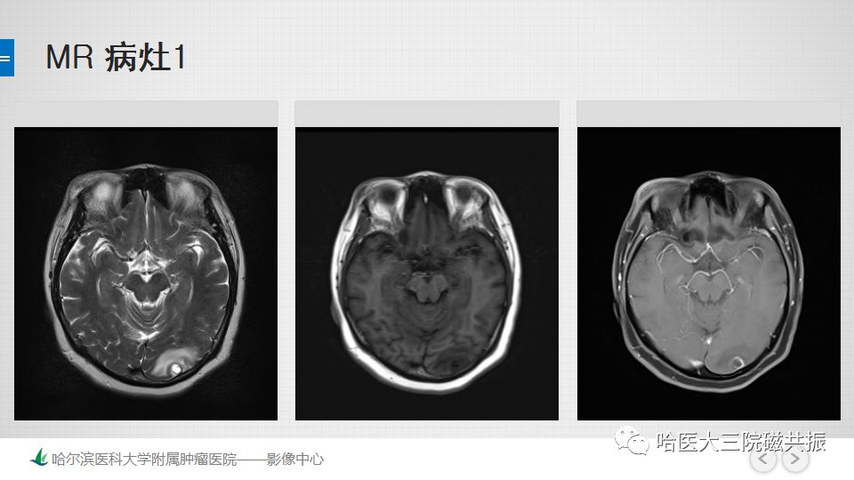 影像PPT - 【PPT】脑内环形强化 除了转移瘤你能想到什么-12