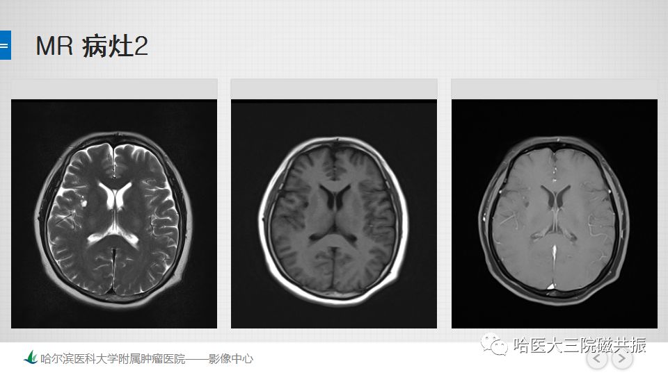 影像PPT - 【PPT】脑内环形强化 除了转移瘤你能想到什么-13