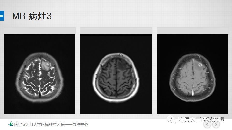 影像PPT - 【PPT】脑内环形强化 除了转移瘤你能想到什么-14