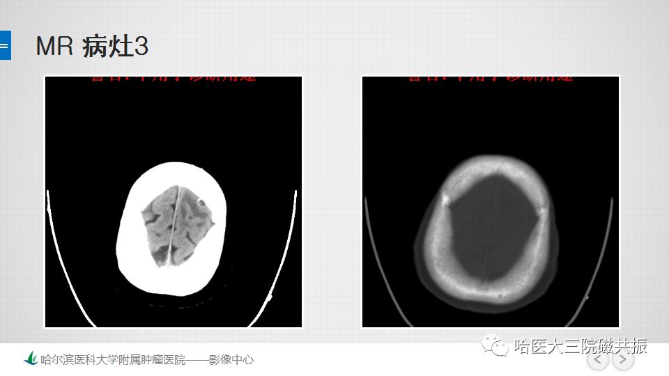 影像PPT - 【PPT】脑内环形强化 除了转移瘤你能想到什么-15