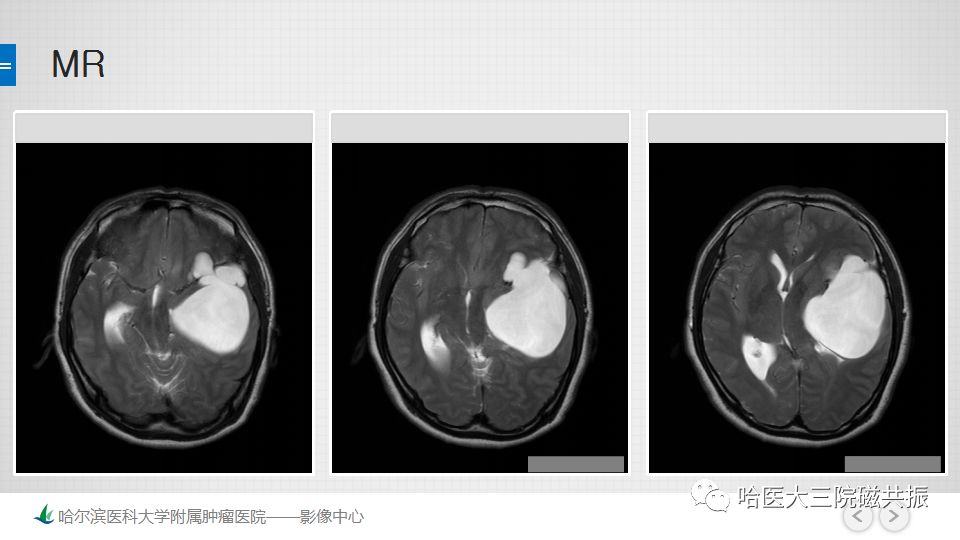 影像PPT - 【PPT】脑内环形强化 除了转移瘤你能想到什么-18