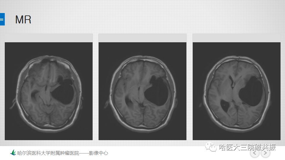 影像PPT - 【PPT】脑内环形强化 除了转移瘤你能想到什么-19