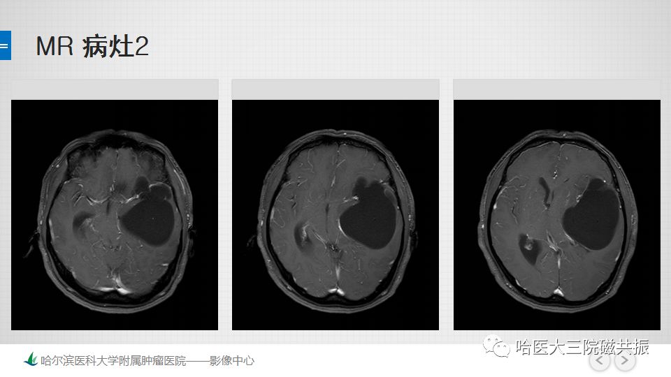 影像PPT - 【PPT】脑内环形强化 除了转移瘤你能想到什么-20