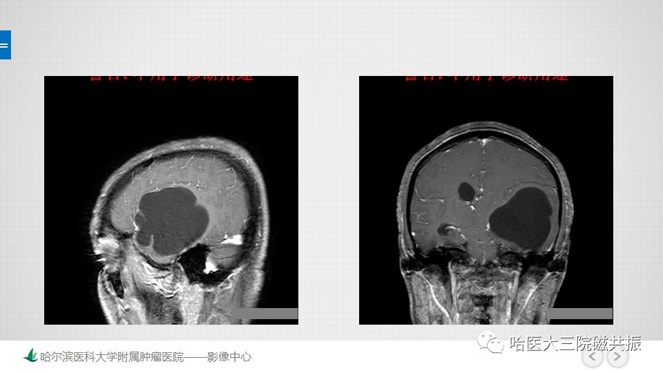 影像PPT - 【PPT】脑内环形强化 除了转移瘤你能想到什么-21